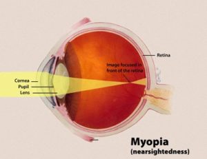 Myopia 2