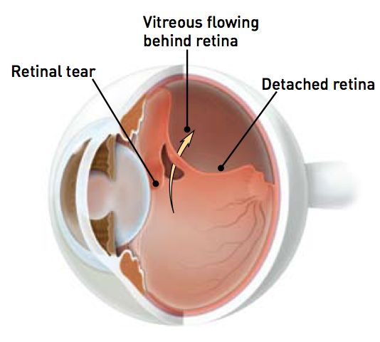 retinal detachment picture
